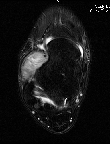 Synovial Sarcoma Soft Tissue Sarcoma